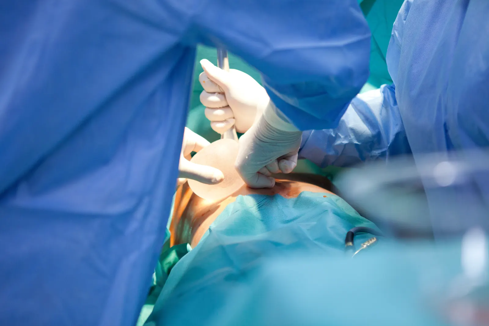 Breast implant surgery in progress